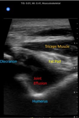 posterior elbow with joint effusion