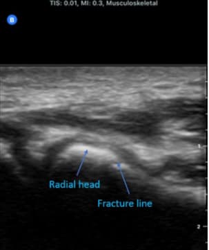 radial head with cortical irregularity and periosteal fluid